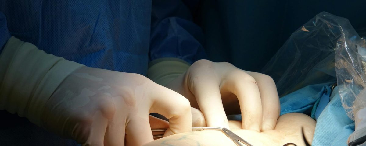 Sympathectomie : guide complet avant de choisir l'intervention