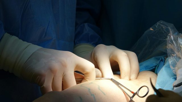 Sympathectomie : guide complet avant de choisir l'intervention